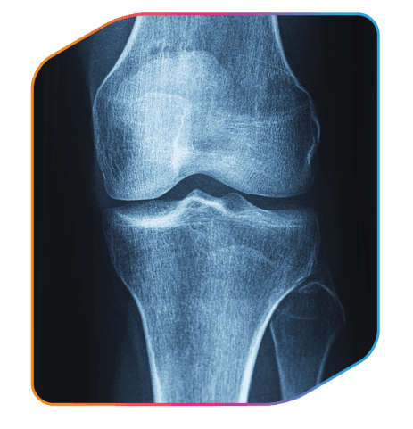 Radiografía de rodilla en frame TERCET